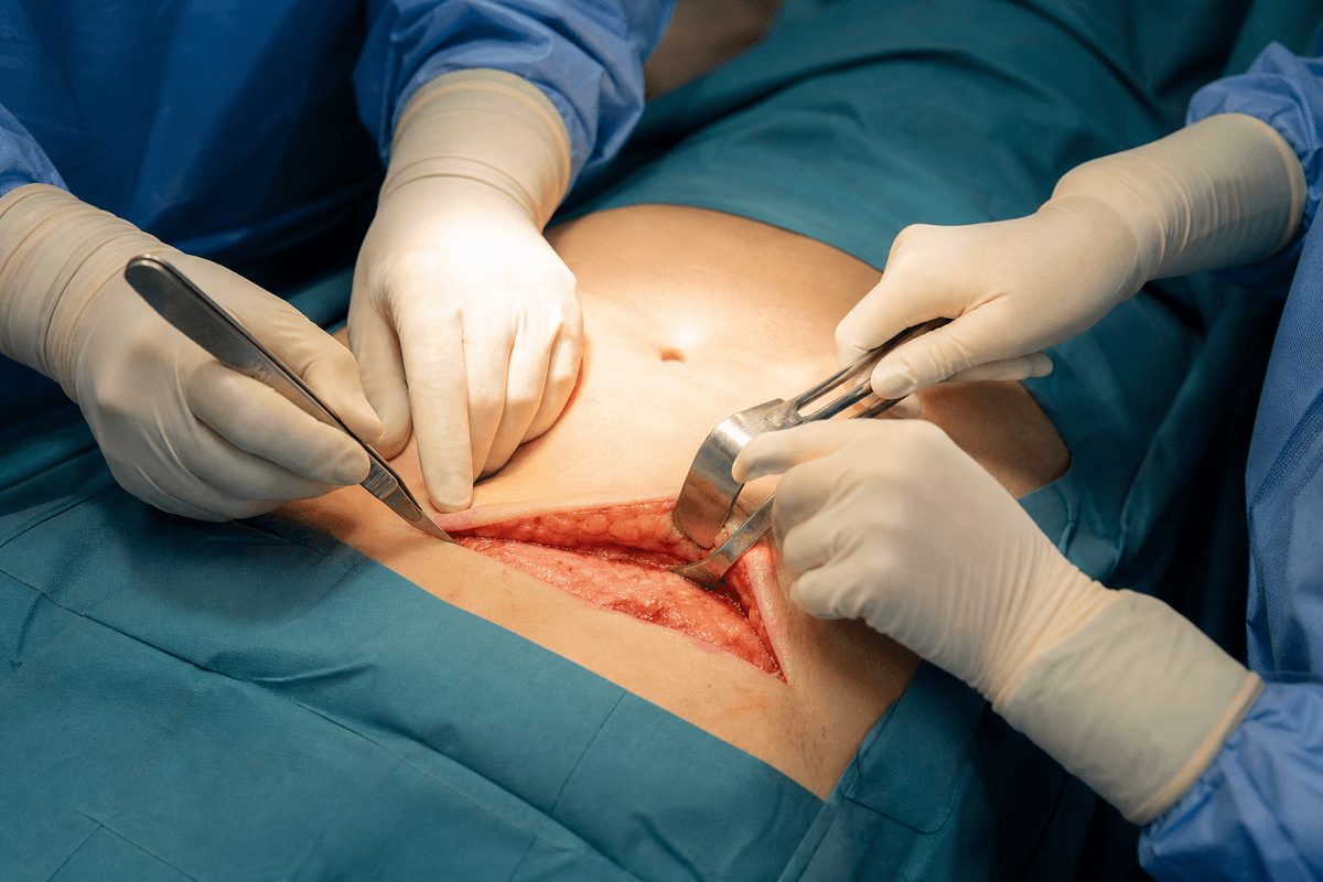 Tummy Tuck