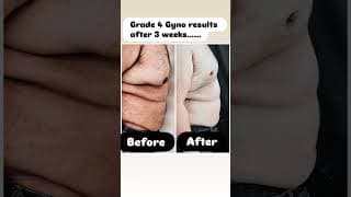 Gynecomastia