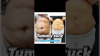 Abdominoplasty